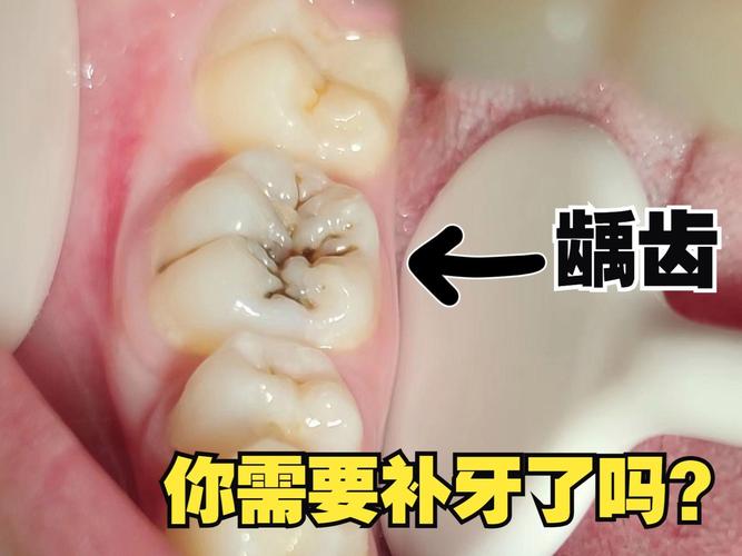 磨蛀牙的钻头喷出来的是什么？水一样的好像补牙时填充完东:补牙钻头掉进嘴巴里