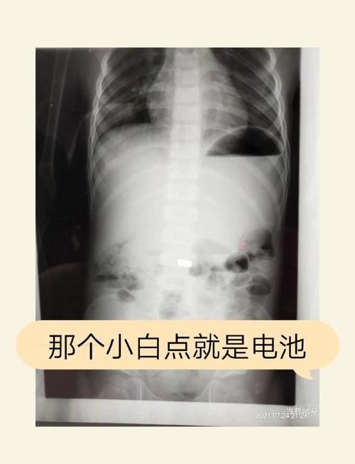 澳门开奖结果开奖记录表013和2岁娃误吞纽扣电池与两岁宝宝误吞纽扣电池